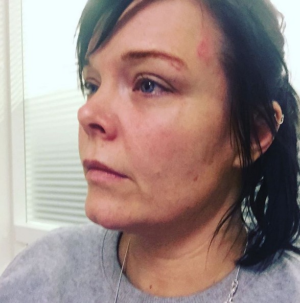 Anette Olzon útok